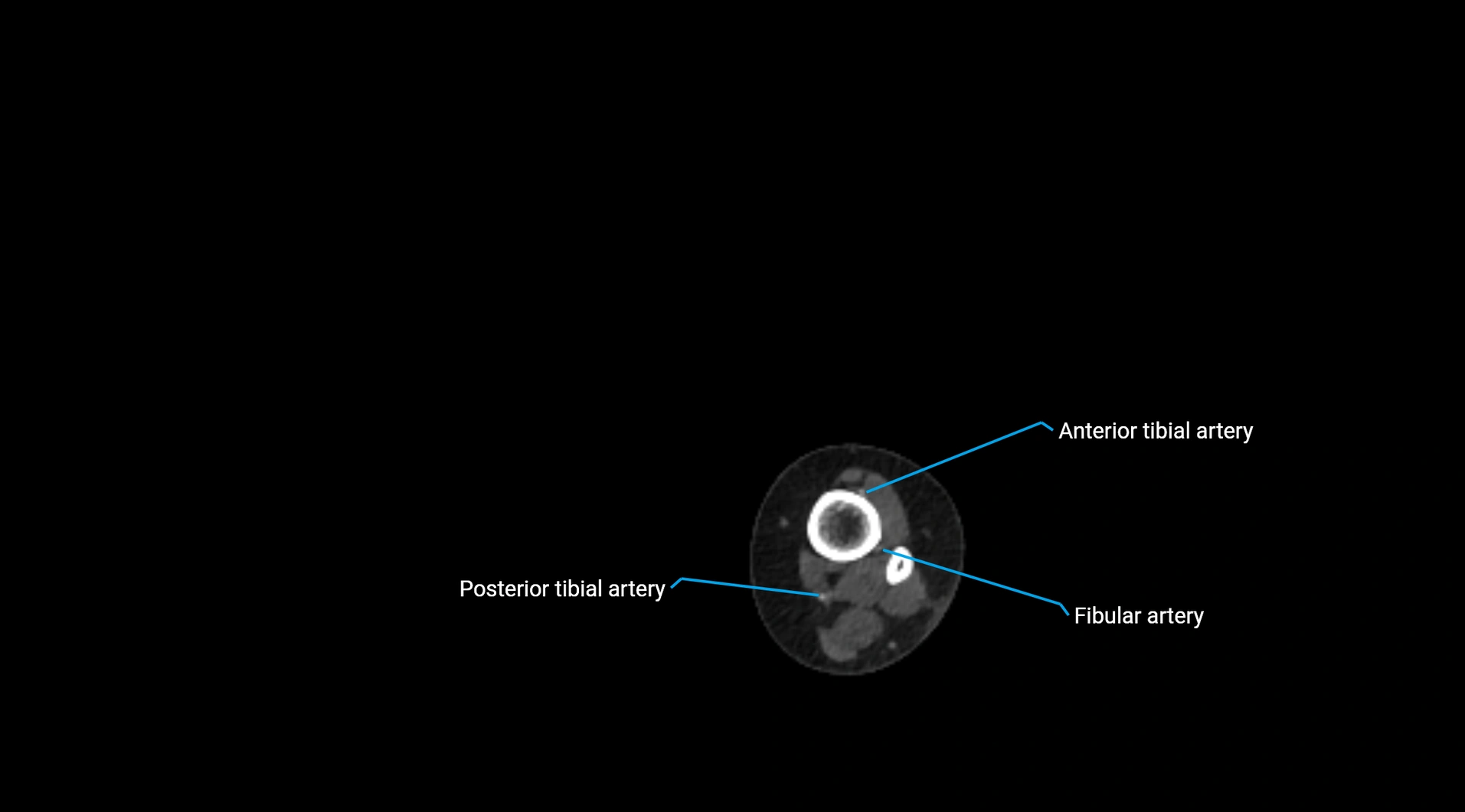 CTA lower limb cross sectional anatomy labelled image _260.webp